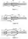 Fig. 04 - Occlusion balloon catheter with longitudinally expandable balloon