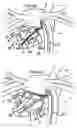 Fig. 05 - Systems for heart treatment