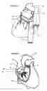 Fig. 12 - Systems for heart treatment