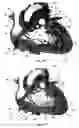 Fig. 34 - Systems for heart treatment