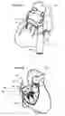 Fig. 12 - Systems for heart treatment