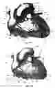 Fig. 34 - Systems for heart treatment