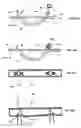 Fig. 46 - Systems for heart treatment