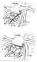 Fig. 05 - Systems for heart treatment