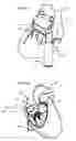 Fig. 12 - Systems for heart treatment