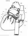 Fig. 16 - Systems for heart treatment