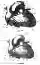 Fig. 34 - Systems for heart treatment