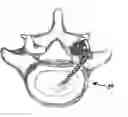 Fig. 01 - Facet joint prosthesis and method of replacing a facet joint