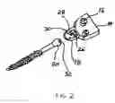 Fig. 03 - Facet joint prosthesis and method of replacing a facet joint