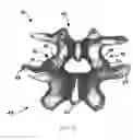 Fig. 06 - Facet joint prosthesis and method of replacing a facet joint