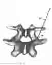 Fig. 07 - Facet joint prosthesis and method of replacing a facet joint