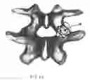 Fig. 13 - Facet joint prosthesis and method of replacing a facet joint