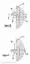Fig. 04 - Shoulder prosthesis