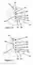 Fig. 08 - Shoulder prosthesis