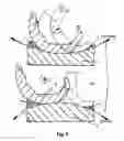 Fig. 04 - Tibia plateau for a replacement joint