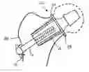 Fig. 01 - Prosthesis