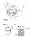 Fig. 02 - Apparatus and methods for treating sleep apnea