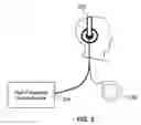 Fig. 04 - Method and apparatus for improving hearing in patients suffering from hearing loss