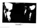 Fig. 08 - Apparatus and methods for enzymatic escharotomy in burn induced compartment syndrome