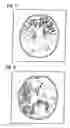 Fig. 02 - Method and apparatus for MR image evaluation by mapping perfusion-weighted and diffusion-weighted MR images