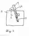 Fig. 11 - Follicular extraction punch and method