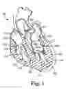 Fig. 02 - Valve treatment catheter and methods