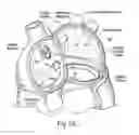 Fig. 07 - Devices, systems, and methods for reshaping a heart valve annulus, including the use of a bridge implant