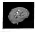 Fig. 20 - Robotic apparatus for targeting and producing deep, focused transcranial magnetic stimulation