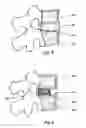 Fig. 04 - Intervertebral disc replacement prothesis