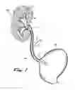 Fig. 02 - Stent kidney curl improvements