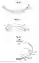 Fig. 07 - Subcutaneous electrode with improved contact shape for transthorasic conduction