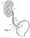 Fig. 02 - Ureteral stent