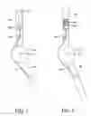 Fig. 08 - Adjustable orthotic brace
