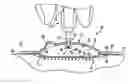 Fig. 01 - Method and device for intradermally delivering a substance