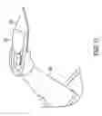 Fig. 12 - Surgical knife blade attachment and method for using same