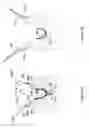 Fig. 14 - Systems and methods employing a push tube for delivering a urethral sling