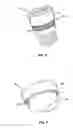 Fig. 07 - Orthopedic fixation system and method of use