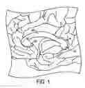 Fig. 02 - Methods of treating neurological conditions by neuromodulation of interhemispheric fibers