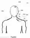Fig. 07 - Transcutaneous implant