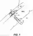 Fig. 02 - Left ventricular conduits and methods for delivery