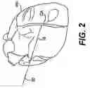 Fig. 03 - Left ventricular conduits and methods for delivery