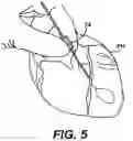 Fig. 07 - Left ventricular conduits and methods for delivery