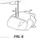 Fig. 10 - Left ventricular conduits and methods for delivery
