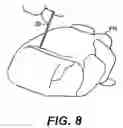 Fig. 13 - Left ventricular conduits and methods for delivery