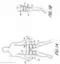 Fig. 02 - High-efficiency external counterpulsation apparatus and method for performing the same