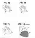 Fig. 02 - Systems and methods for assisting cardiac valve coaptation