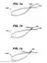 Fig. 06 - Systems and methods for assisting cardiac valve coaptation