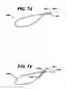 Fig. 07 - Systems and methods for assisting cardiac valve coaptation