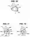 Fig. 12 - Systems and methods for sizing cardiac assist device