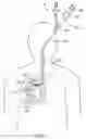 Fig. 02 - Delivery methods and devices for implantable bronchial isolation devices